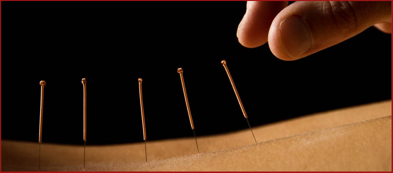 Akupunktura 