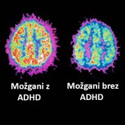 ADHD-možgani